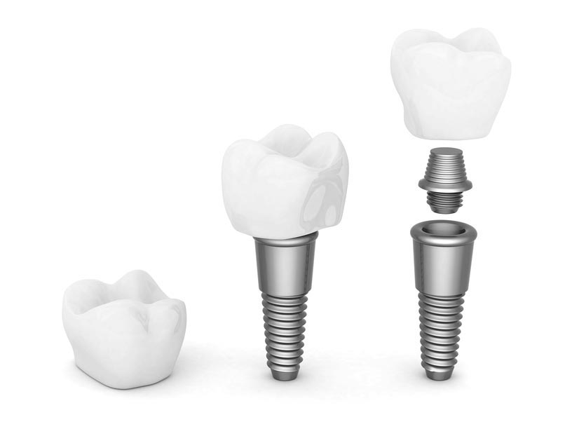 Dental Implant